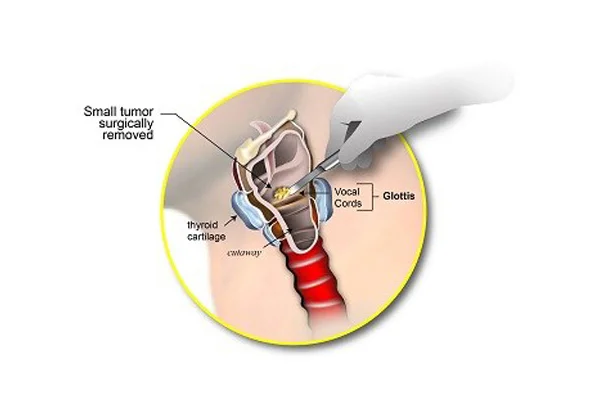 Microlaryngeal Surgery