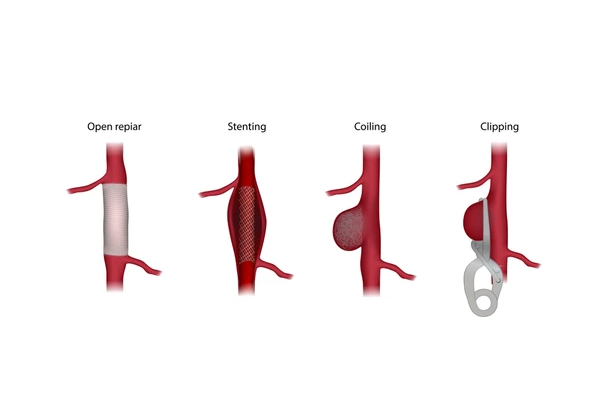 Aneurysm Surgery