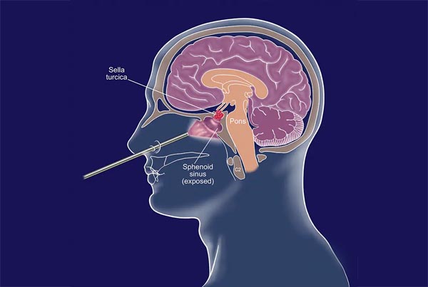 Endoscopic Pituitary Surgery