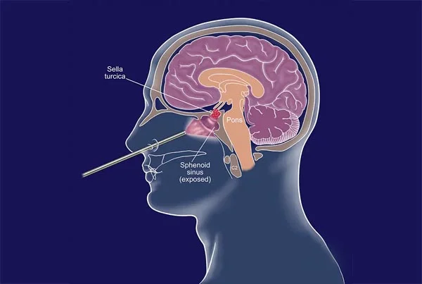 Endoscopic Pituitary Surgery