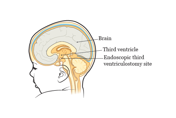 Endoscopic Ventriculostomy for Hydrocephalus