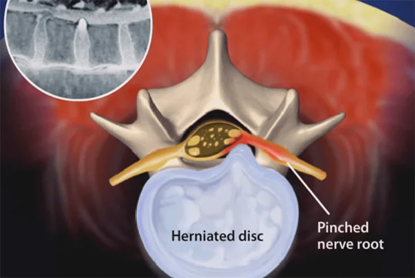 Endoscopic Lumbar Disc Surgery