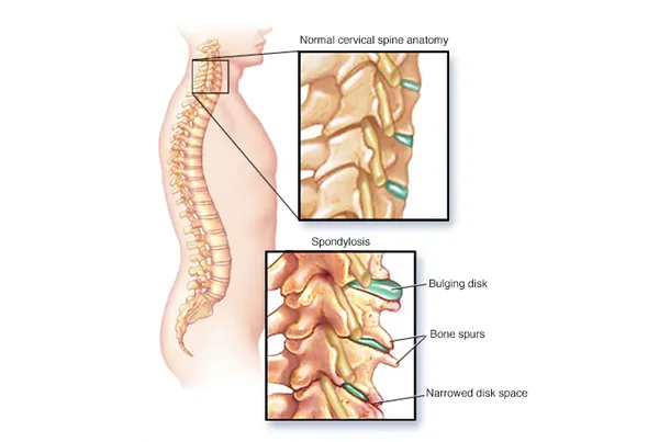 Cervical Spondylosis