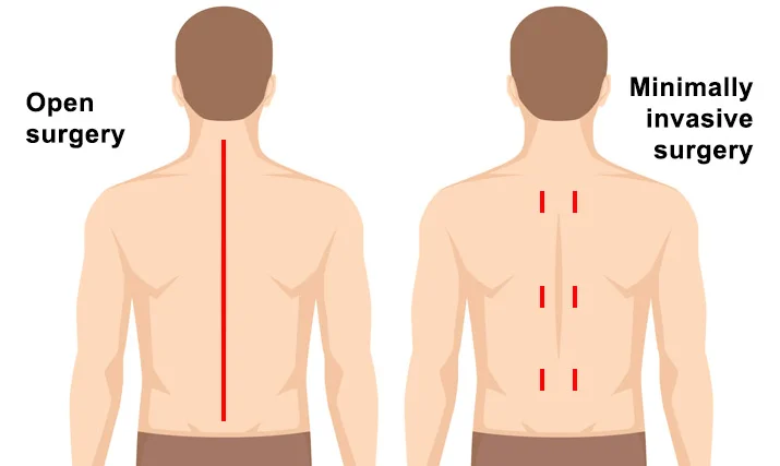 Minimal Invasive Spine Surgery