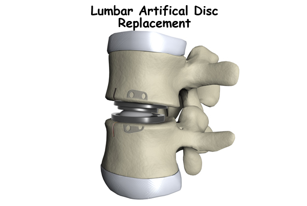 Lumbar Disc Surgery