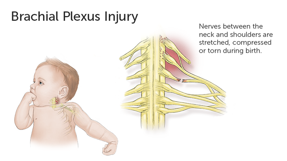 Brachial Plexus Surgery