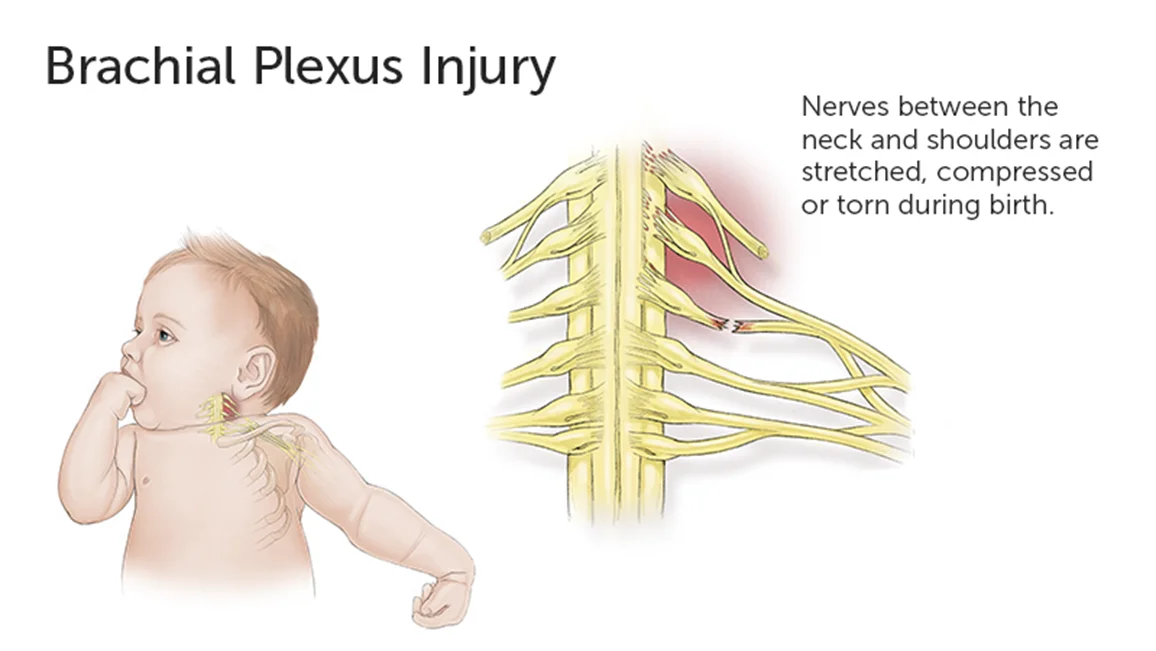Brachial Plexus Surgery