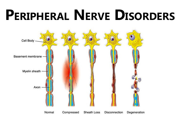 Peripheral Nerve Surgery